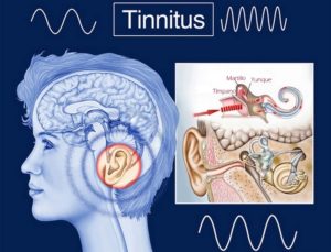 Tinnitus