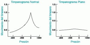 timpanometria4